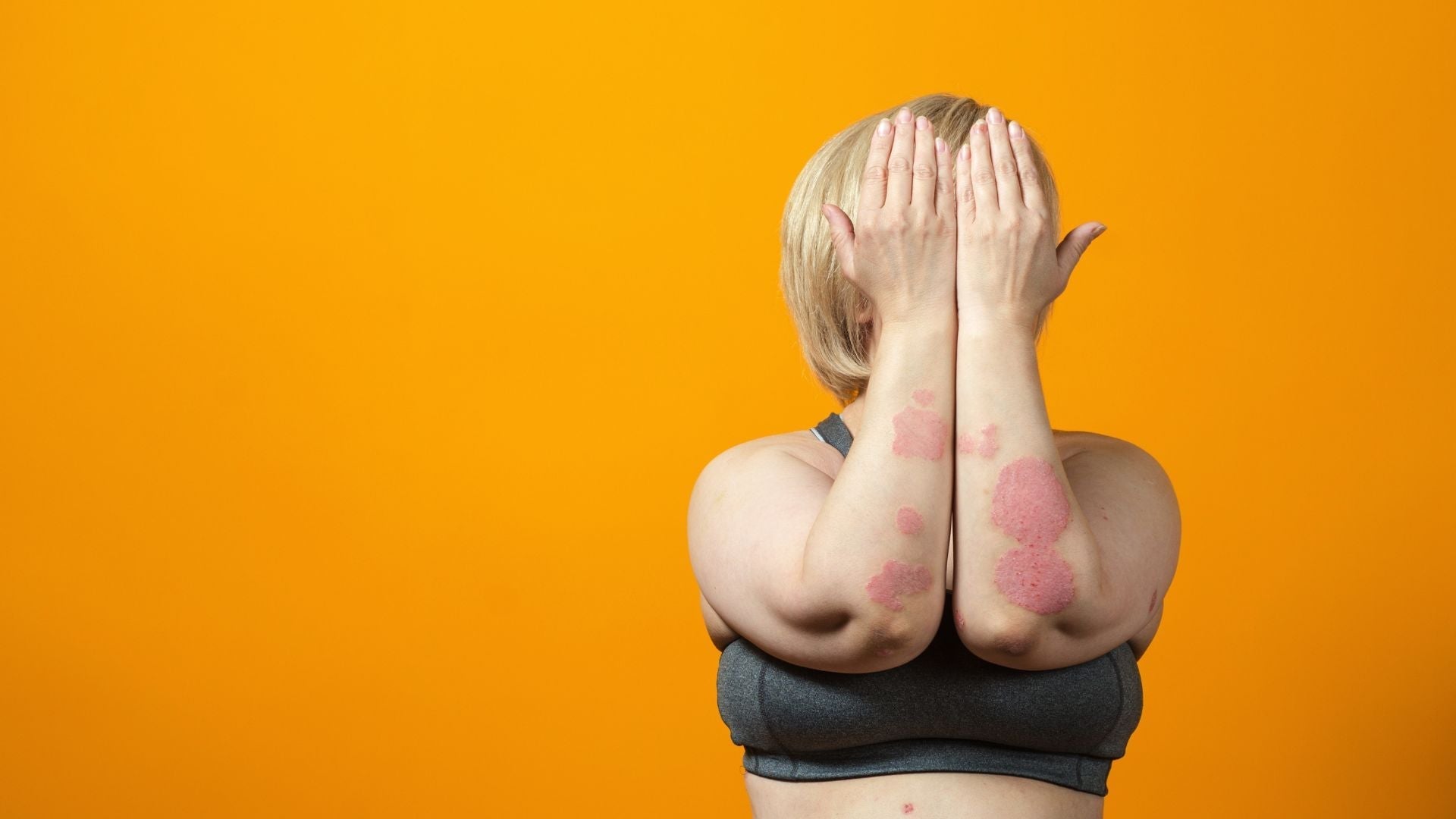 Can Manuka Honey Help with Psoriasis?